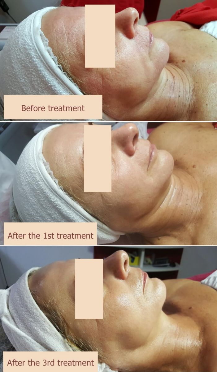 Oxygen treatment results
