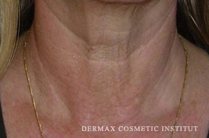 Vitalaser anti-wrinkle treatment neck after