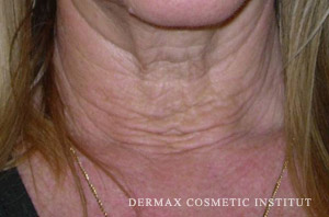 Vitalaser anti-wrinkle treatment neck before
